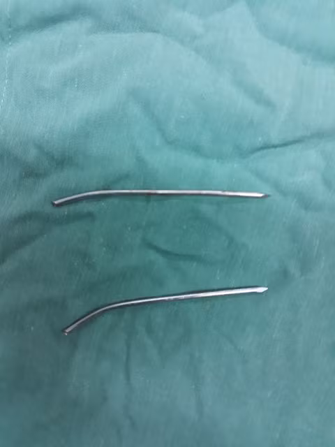 Hai cây đinh cố định xương đòn bị gãy từ hai năm trước được lấy ra khỏi cơ thể ông P. 