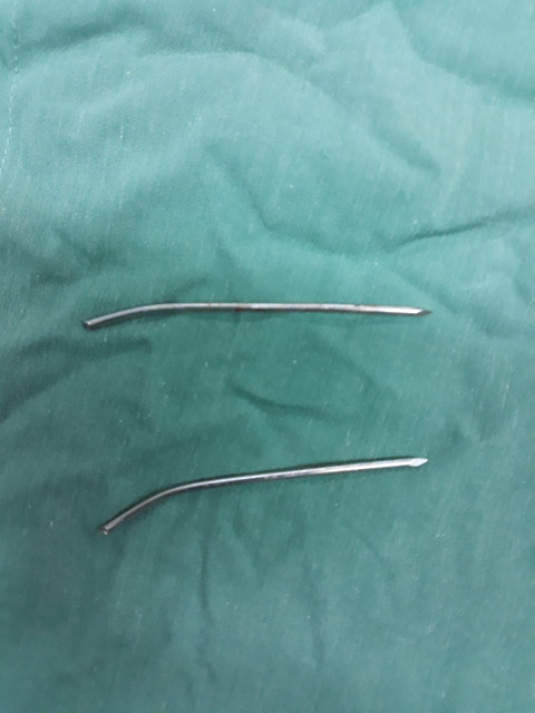 Hai cây đinh cố định xương đòn bị gãy từ hai năm trước được lấy ra khỏi cơ thể ông P. Hai cây đinh cố định xương đòn bị gãy từ hai năm trước được lấy ra khỏi cơ thể ông P.