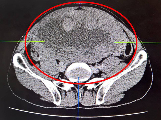  Vị trí khối u chiếm trọn ổ bụng người đàn ông