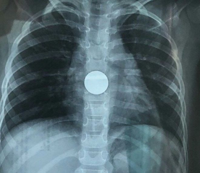 Chụp X-quang phát hiện đồng xu trong ổ bụng bé gái ẢNH: TRẦN THANH PHONG Chụp X-quang phát hiện đồng xu trong ổ bụng bé gái ẢNH: TRẦN THANH PHONG