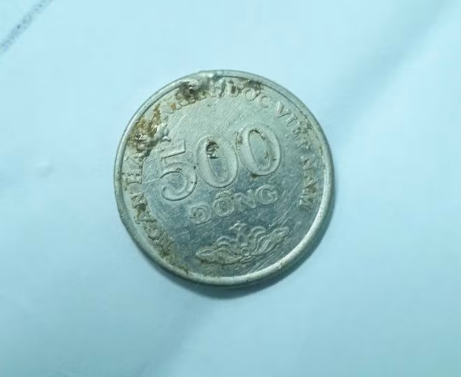 Đồng xu được nội soi gặp ra từ trong ổ bụng bé gái- Ảnh: TRẦN THANH PHONG