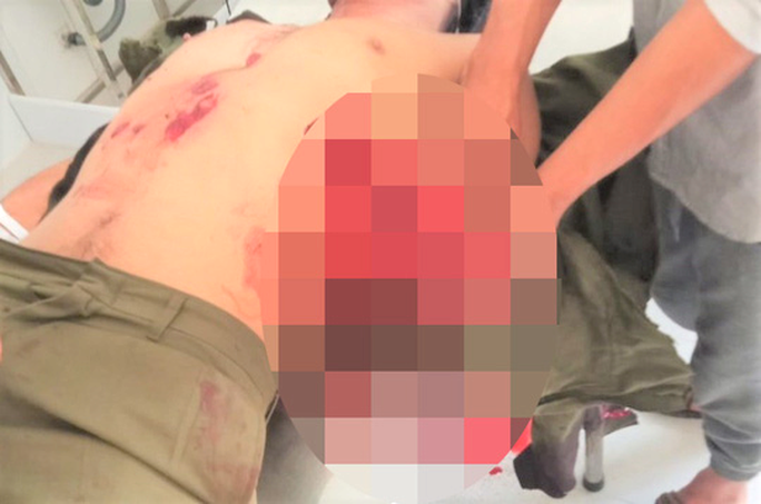 Vụ nổ mìn tự chế khiến 1 người bị mất hoàn toàn bàn tray trái và 6 người khác bị thương. Vụ nổ mìn tự chế khiến 1 người bị mất hoàn toàn bàn tray trái và 6 người khác bị thương.