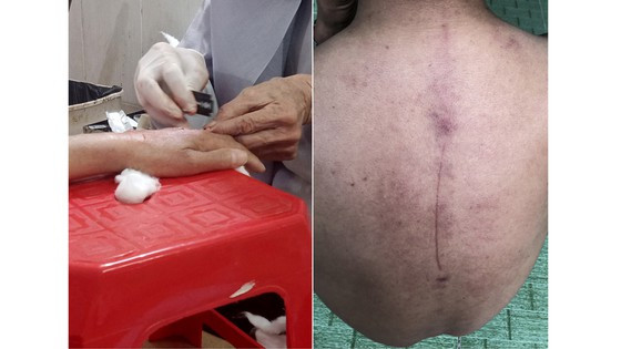Dùng dao lam chữa bệnh tại chùa Ưu Đàm, TP Thủ Đức (ảnh trái) và “hậu quả” sau khi bị đệ tử thầy Tư nện để chữa bệnh