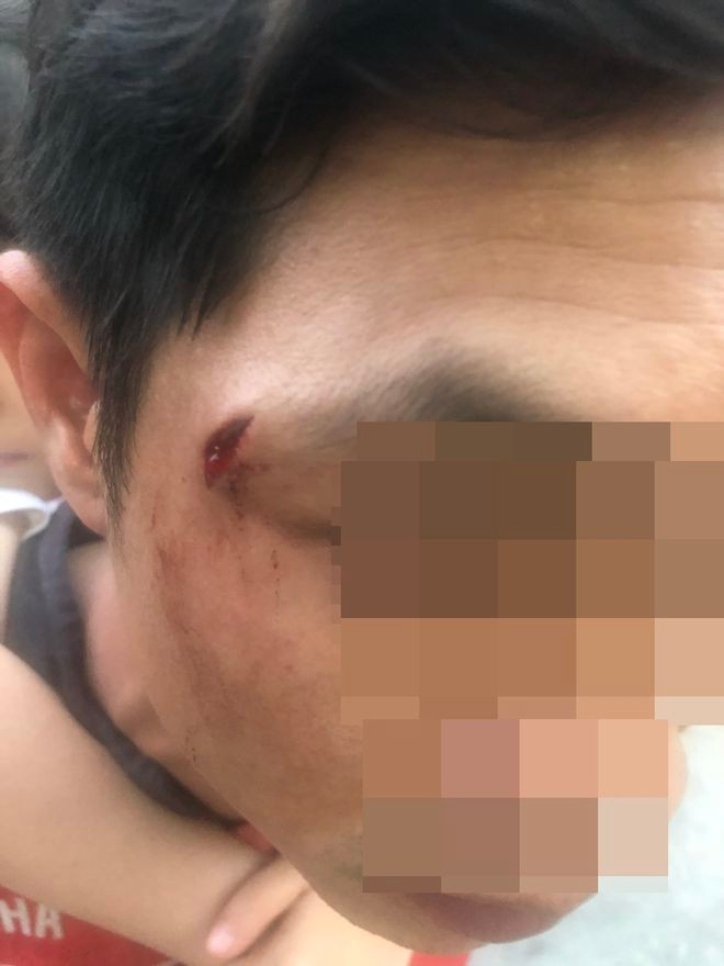 Anh Đ.D.M, nhân viên tiệm T.B bị đánh rách vùng thái dương. Ảnh: ĐỨC NHẬT