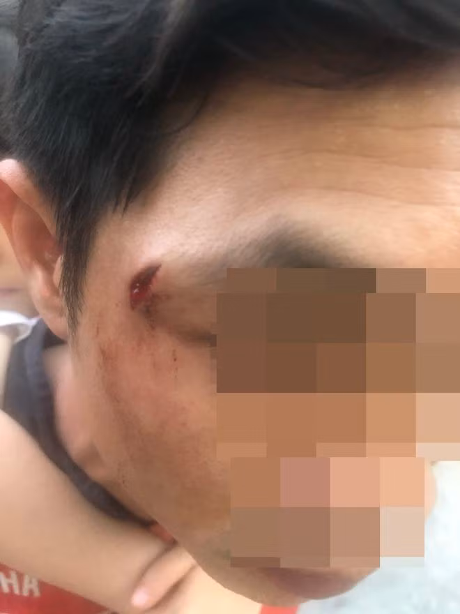 Anh Đ.D.M, nhân viên tiệm T.B bị đánh rách vùng thái dương. Ảnh: ĐỨC NHẬT