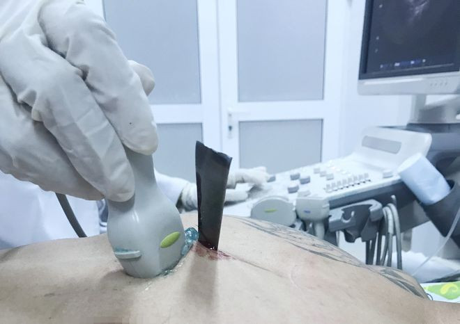 Vết thương thấu ngực gây thủng tim nguy hiểm. ẢNH DO BỆNH VIỆN CUNG CẤP