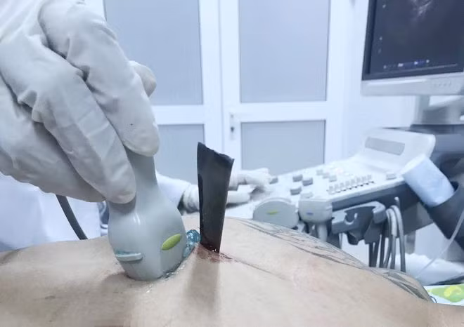 Vết thương thấu ngực gây thủng tim nguy hiểm. ẢNH DO BỆNH VIỆN CUNG CẤP