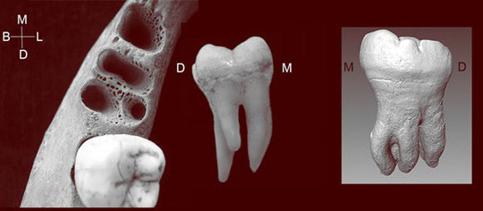  Những chiếc răng kỳ dị 3 chân được tìm thấy ở nhiều người châu Á hiện đại lẫn loài người tuyệt chủng Denisovans - ảnh: Đại học California