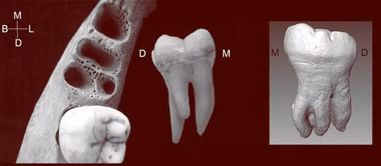  Những chiếc răng kỳ dị 3 chân được tìm thấy ở nhiều người châu Á hiện đại lẫn loài người tuyệt chủng Denisovans - ảnh: Đại học California