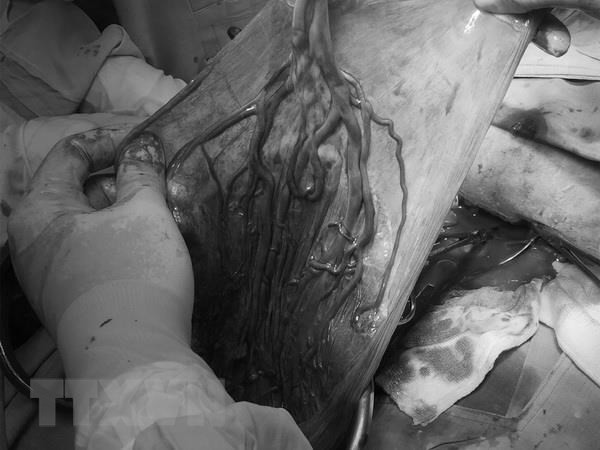  Hình ảnh dây rốn bám màng. (Ảnh: TTXVN phát)