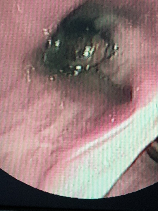 Hạt vú sữa nằm trong phế quản bệnh nhân T. suốt 1 tháng Hạt vú sữa nằm trong phế quản bệnh nhân T. suốt 1 tháng