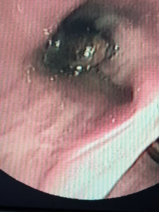 Hạt vú sữa nằm trong phế quản bệnh nhân T. suốt 1 tháng Hạt vú sữa nằm trong phế quản bệnh nhân T. suốt 1 tháng