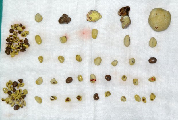 Những viên sỏi được lấy ra khỏi thận phải của bệnh nhân. (Ảnh: Trung Kiên/TTXVN)