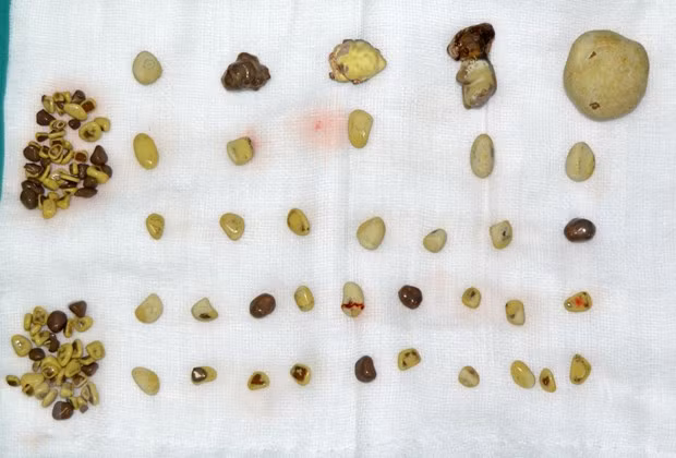 Những viên sỏi được lấy ra khỏi thận phải của bệnh nhân. (Ảnh: Trung Kiên/TTXVN)