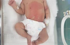 Cháu M.H.P.L đang được điều trị tại Bệnh viện Hữu nghị Việt Nam-Cuba Đồng Hới. (Ảnh: TTXVN phát)