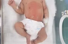 Cháu M.H.P.L đang được điều trị tại Bệnh viện Hữu nghị Việt Nam-Cuba Đồng Hới. (Ảnh: TTXVN phát)