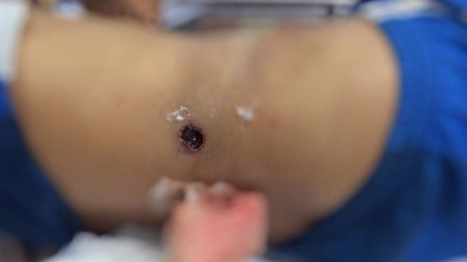 Vết thương do súng săn cướp cò ăn sâu vào ổ bụng