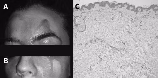 Nữ bệnh nhân với khuôn mặt thường xuyên ướt đẫm máu - ảnh do nhóm nghiên cứu cung cấp.