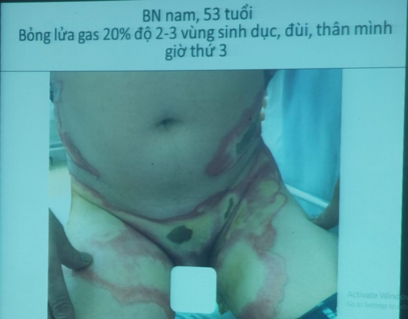 Bật lửa phát nổ gây bỏng nặng vùng dưới của nạn nhân. Bật lửa phát nổ gây bỏng nặng vùng dưới của nạn nhân.