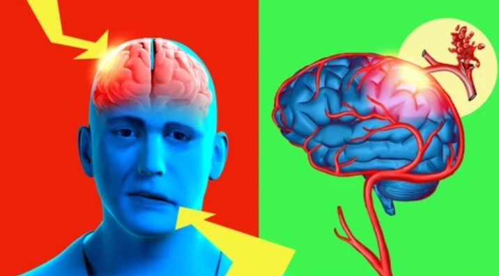  … và giảm đến 59% đột quỵ do cục máu đông. Ảnh: Shutterstock