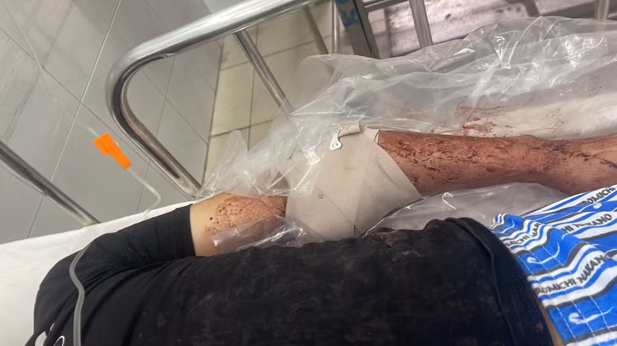 Anh B. nhập viện với cánh tay gần đứt lìa. Ảnh: Văn Tiến