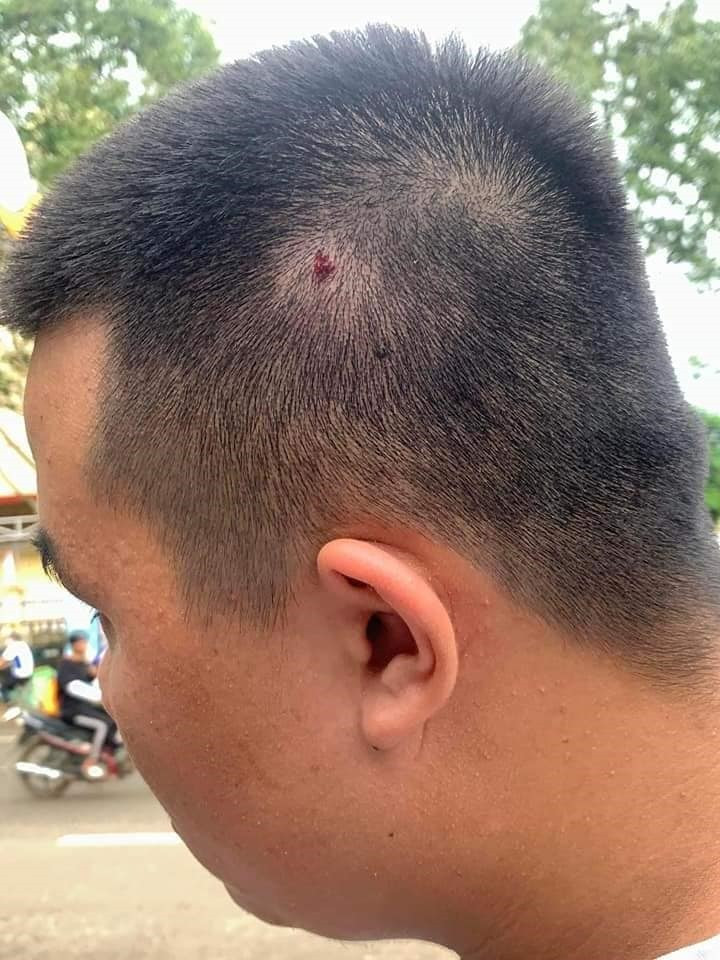 Vết thương của học sinh sau khi bị đánh. Ảnh: T.X