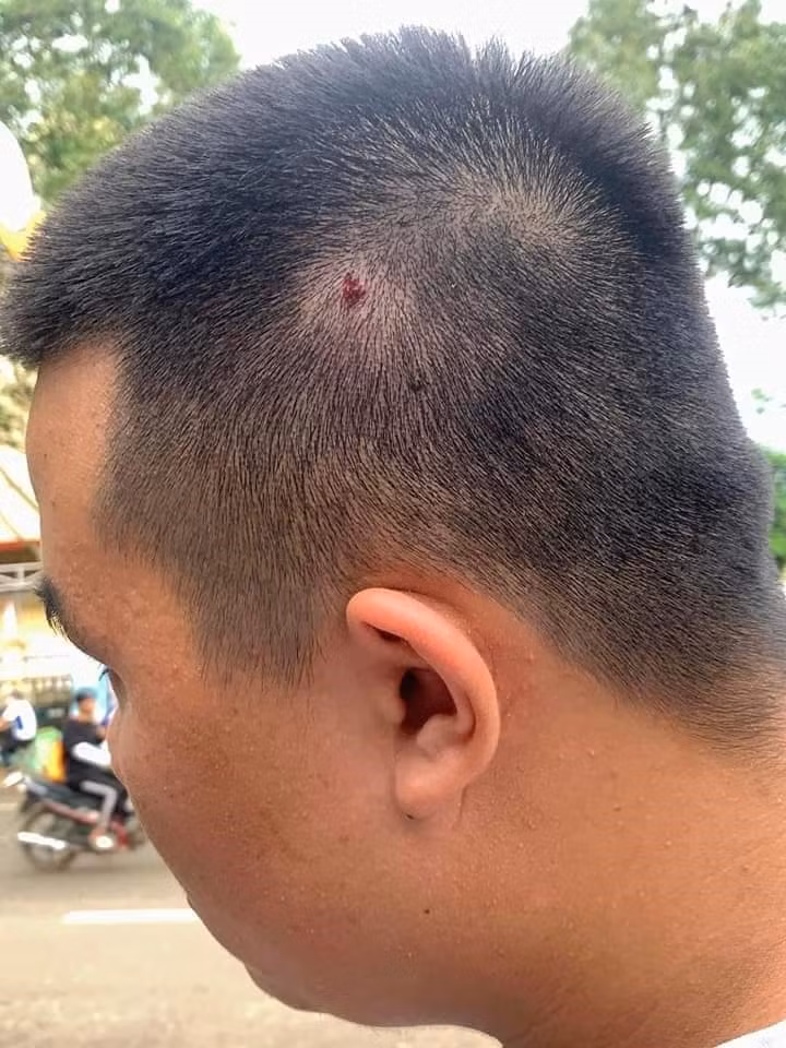 Vết thương của học sinh sau khi bị đánh. Ảnh: T.X