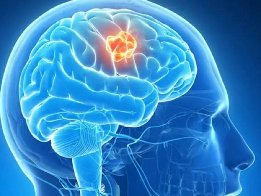 Cô Emma Webster, 29 tuổi, tưởng bị đau do sâu răng nhưng thật ra đó là triệu chứng của khối u não. Ảnh minh họa: SHUTTERSTOCK Cô Emma Webster, 29 tuổi, tưởng bị đau do sâu răng nhưng thật ra đó là triệu chứng của khối u não. Ảnh minh họa: SHUTTERSTOCK