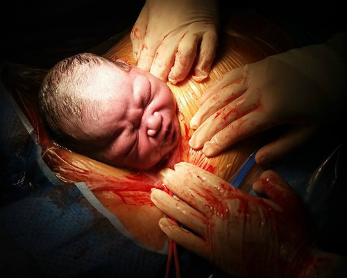 Bé được các bác sĩ rạch bọc ối đưa ra ngoài. Ảnh: C.T