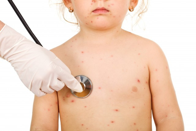 Bệnh thủy đậu là một bệnh cấp tính do nhiễm virus Varicella Zoter. Bệnh thủy đậu là một bệnh cấp tính do nhiễm virus Varicella Zoter.