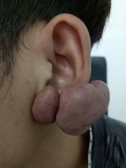 Bệnh nhân M. bị sẹo lồi chiếm gần hết dái tai (Ảnh Phan Văn Tú)