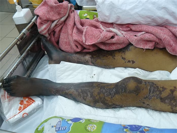 Một bệnh nhân xuất hiện nhiều vết hoại tử trên da do nhiễm liên cầu lợn