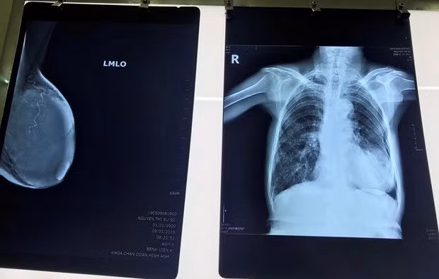 Phim chụp khối u của bệnh nhân. (Ảnh: PV/Vietnam+) Phim chụp khối u của bệnh nhân. (Ảnh: PV/Vietnam+)