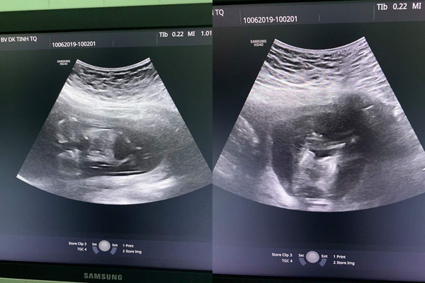  Hình ảnh siêu âm cho thấy 2 thai nhi dính nhau từ ngực tới bụng, chung 1 quả tim hết sức hiếm gặp 