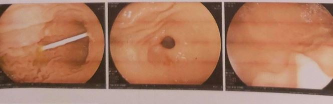 Hình ảnh dị vật trong quá trình nội soi.