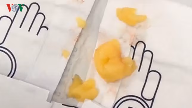  Dị vật là rất nhiều thạch rau câu được lấy ra từ phế quản bệnh nhi.