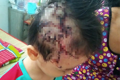 Bé trai bị chó cắn tét da đầu. Ảnh: BVCC Bé trai bị chó cắn tét da đầu. Ảnh: BVCC