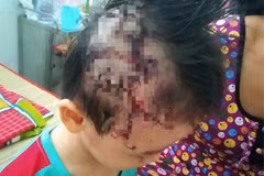 Bé trai bị chó cắn tét da đầu. Ảnh: BVCC