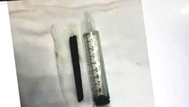 Dị vật nửa chiếc đũa dài 9cm được lấy ra khỏi vùng mũi bệnh nhân. Ảnh: HL Dị vật nửa chiếc đũa dài 9cm được lấy ra khỏi vùng mũi bệnh nhân. Ảnh: HL
