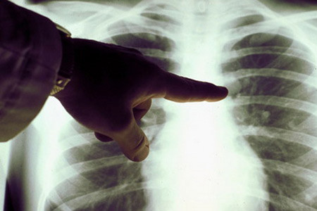 13,3 triệu người chết vì ung thư mỗi năm ảnh 1