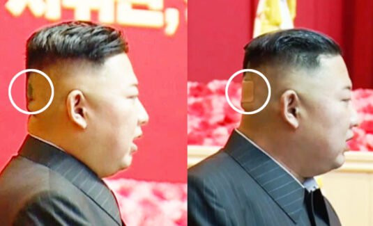  Miếng băng dán ở sau đầu ông Kim Jong-un. Ảnh: Twitter