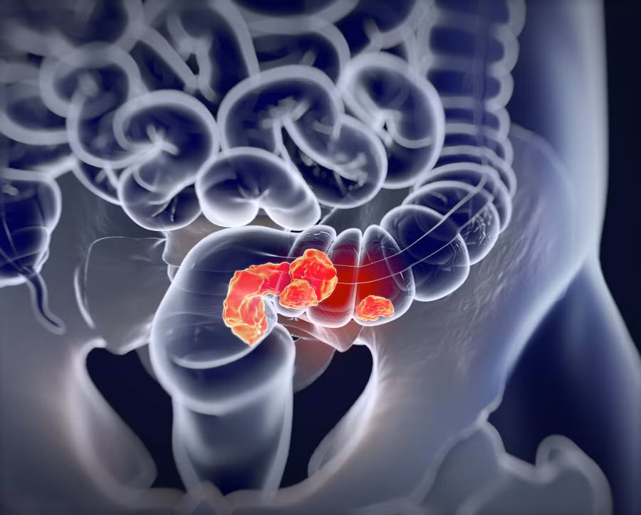 Ung thư đại trực tràng, minh họa giải phẫu y tế. Ảnh: Shutterstock