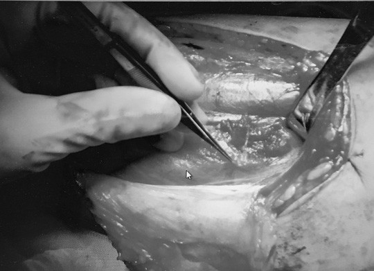 Phần lớn bệnh nhân ung thư dương vật nhập viện trong tình trạng muộn