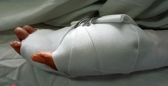 Bàn tay trái của chị H. được khớp nối thành công