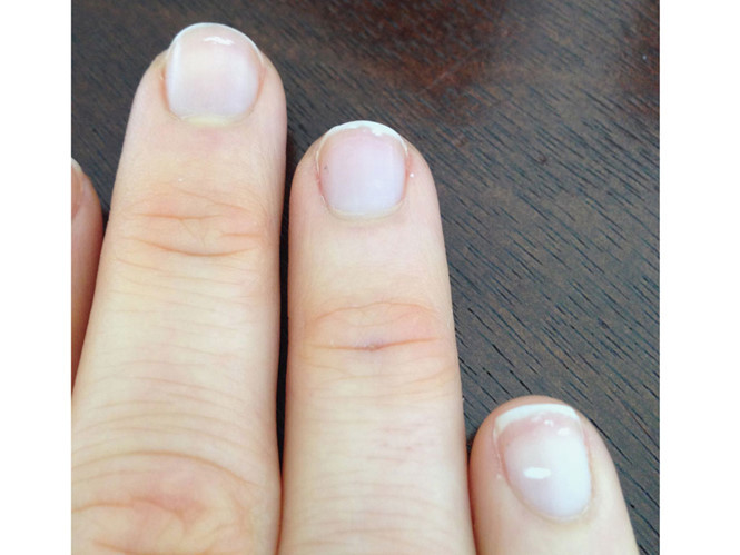  Đốm trắng ở móng lan rộng ra sẽ là dấu hiệu của bệnh nặng