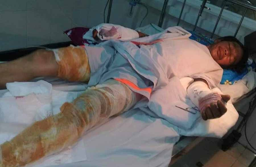  Anh Huỳnh Văn Thiện đang điều trị tại Bệnh viện Chợ Rẫy (TP. Hồ Chí Minh). Ảnh: Đ.Y