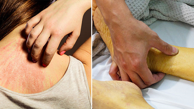 Nếu đã giữ đủ nước và giảm lượng natri mà vẫn không bớt ngứa. Đó có thể là dấu hiệu cảnh báo rằng đã đến lúc phải đi khám - Ảnh minh họa: Shutterstock