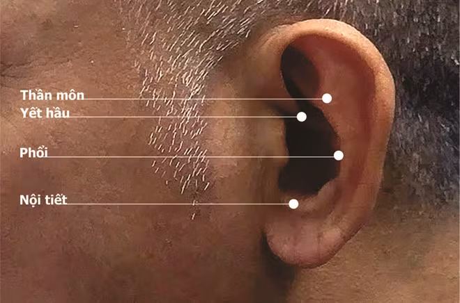 Vị trí nhĩ châm cai thuốc lá - Ảnh: Nam Sơn