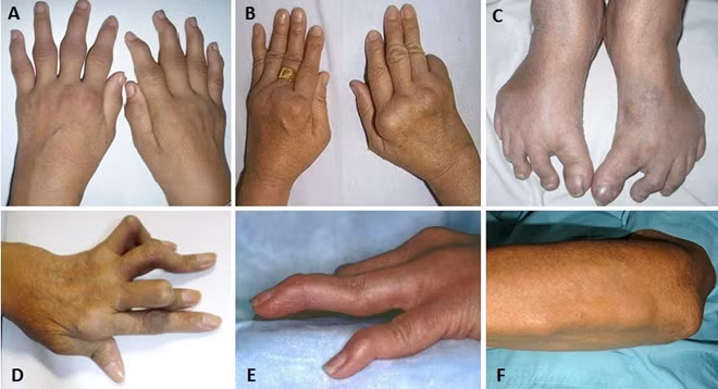 Các biến chứng do viêm khớp dạng thấp - Ảnh BVCC