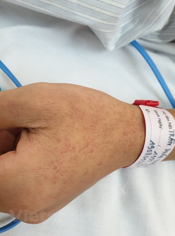 Bệnh nhân mắc sốt xuất huyết. (Ảnh: PV/Vietnam+) Bệnh nhân mắc sốt xuất huyết. (Ảnh: PV/Vietnam+)